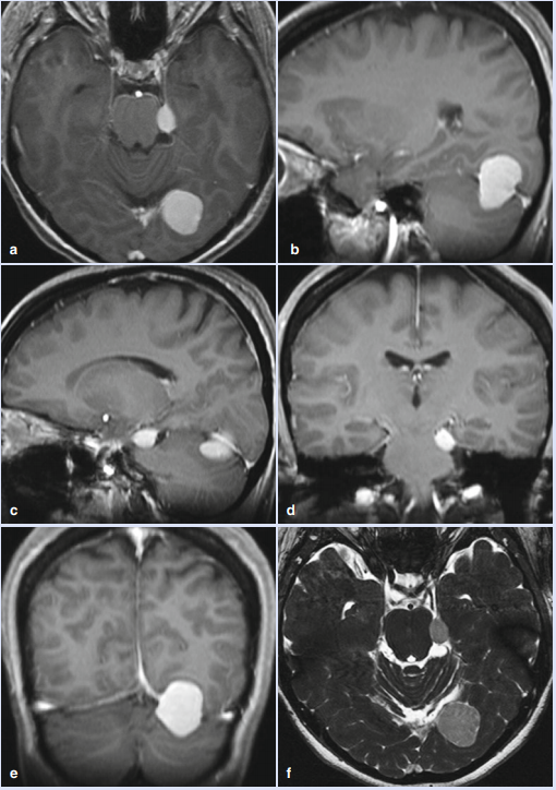 小脑幕脑膜瘤6大分型与手术入路选择，INC巴特朗菲教授疑难手术案例解读