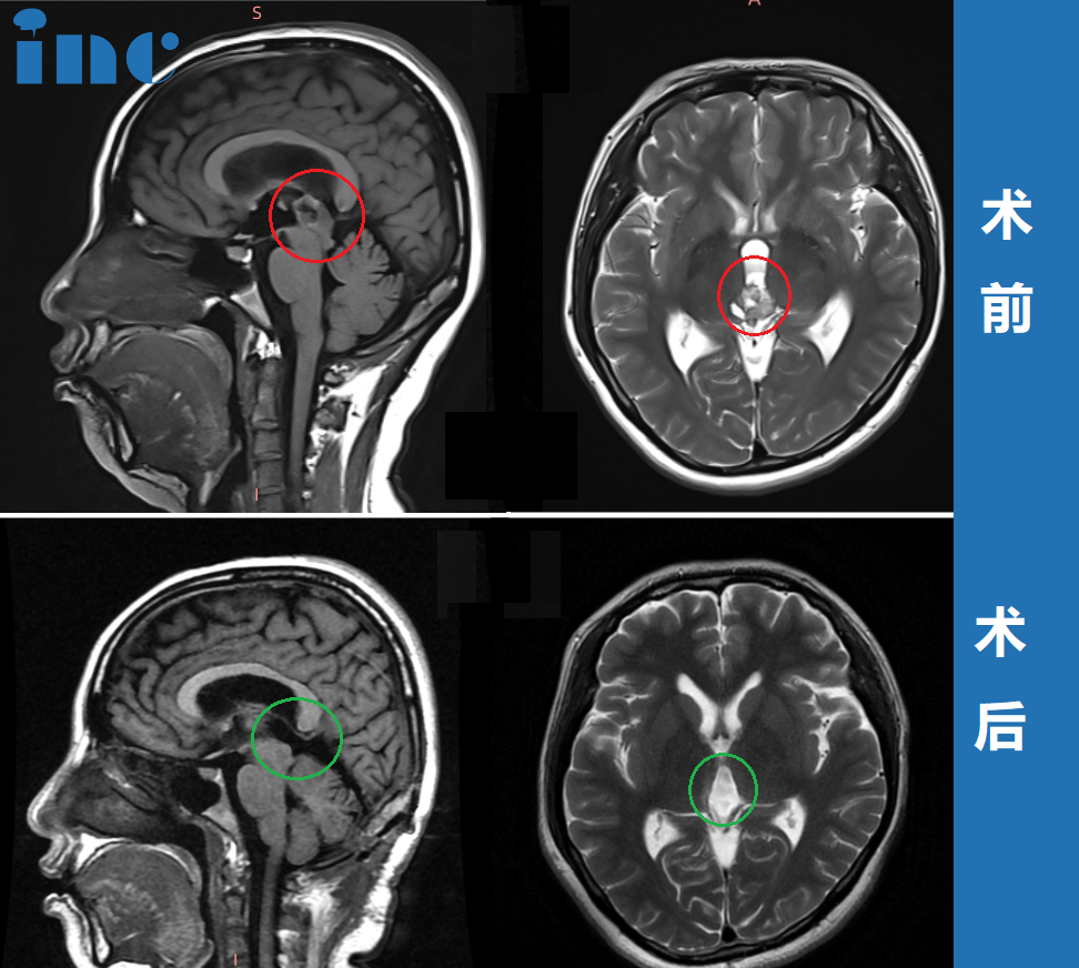 巴特朗菲