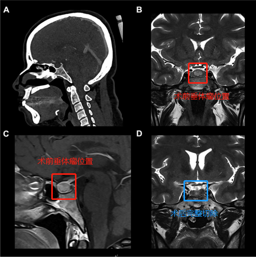 颅底脊索瘤案例