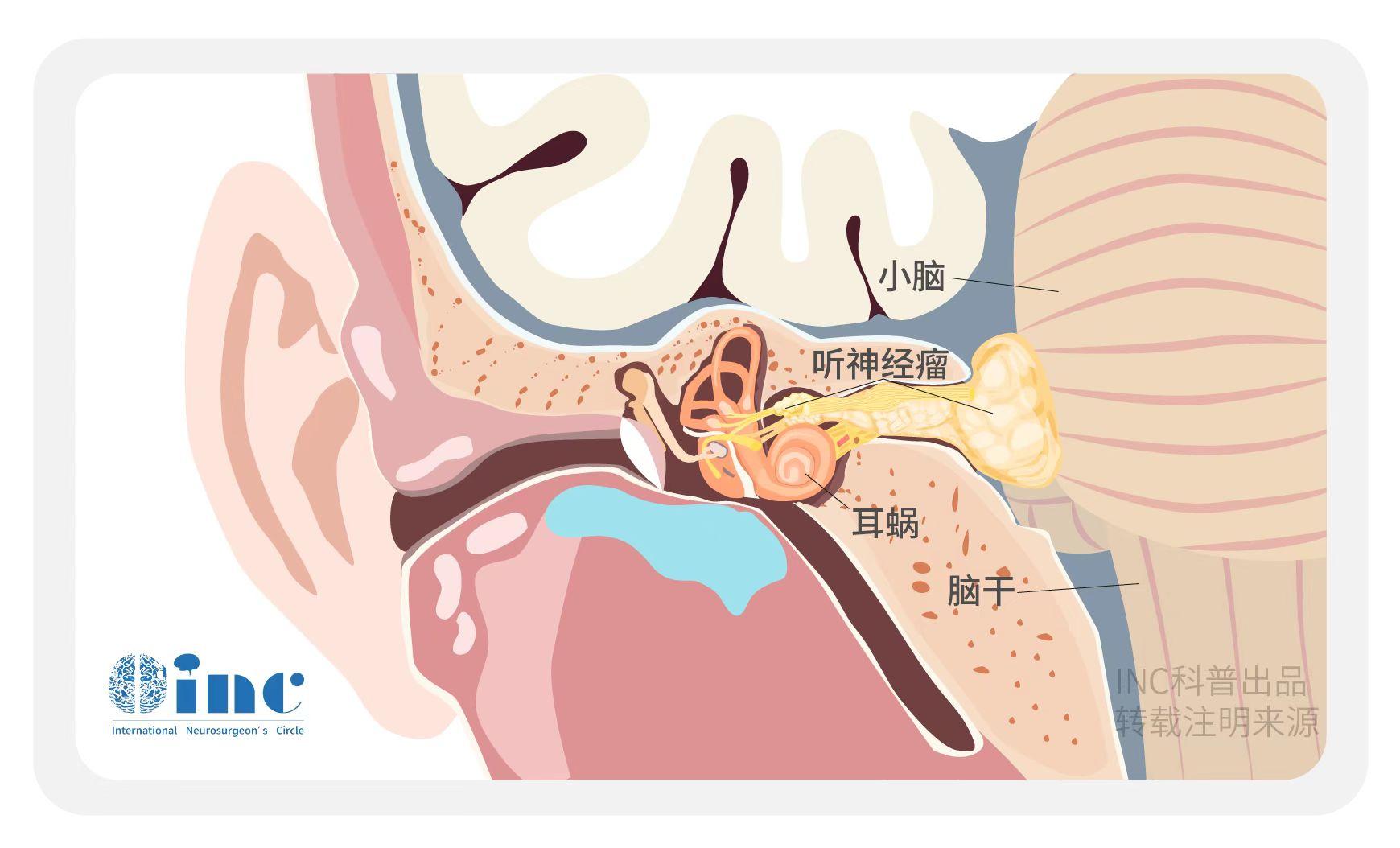 关于听神经瘤手术切除中的面、听神经保护 - 微医（挂号网）