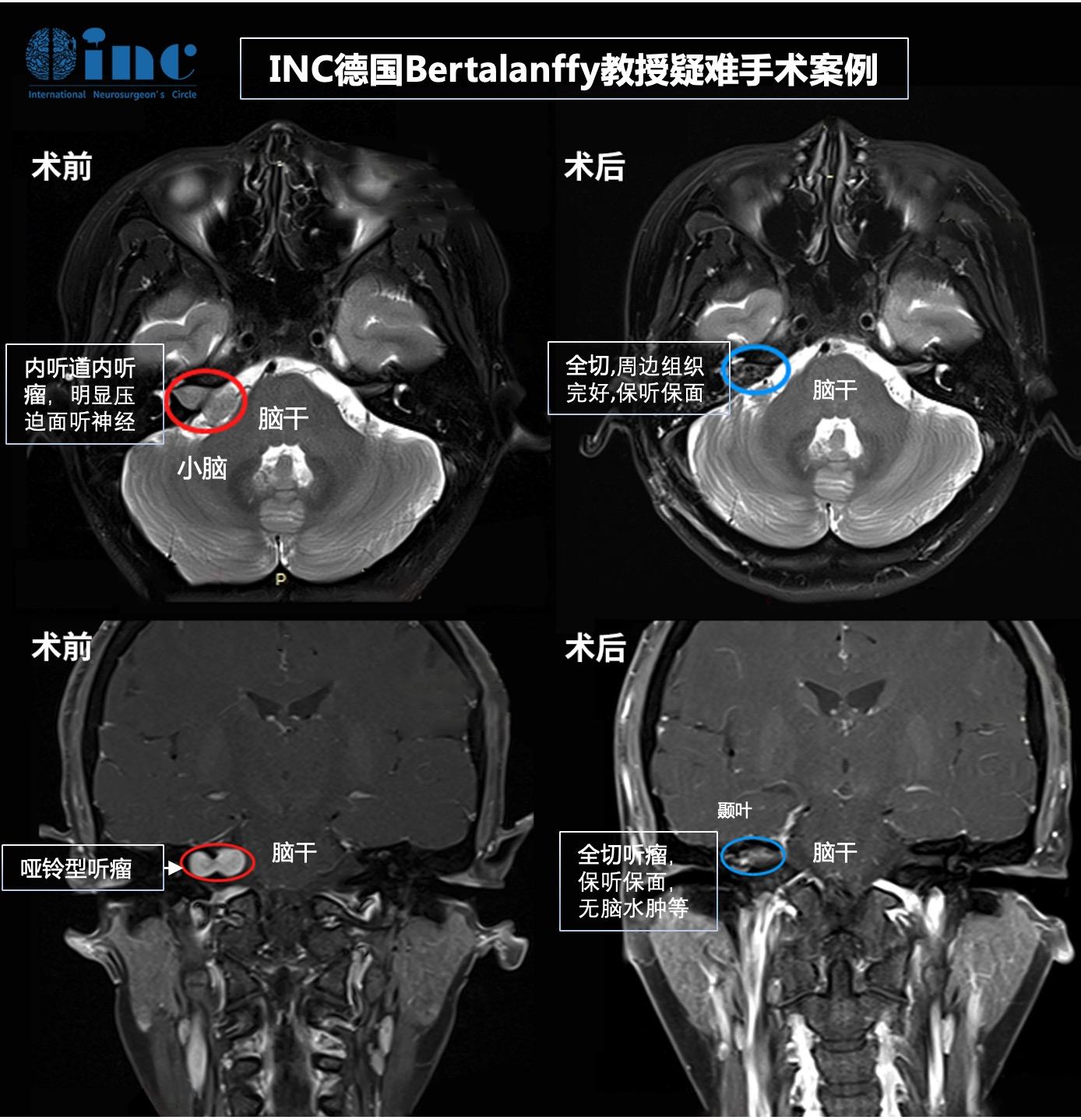 听神经瘤进展会出现哪9大症状？治疗后都能恢复吗？手术关键是什么？