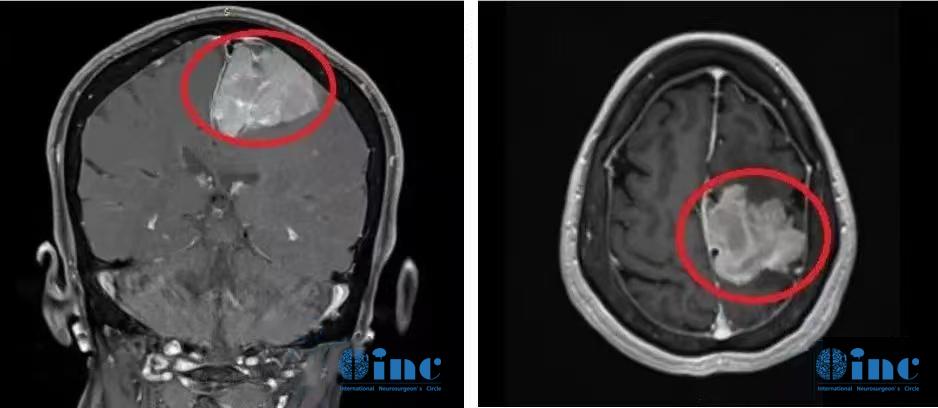 巨大脑膜瘤长在大静脉窦、大脑镰旁能治愈吗，复杂脑膜瘤的治疗策略