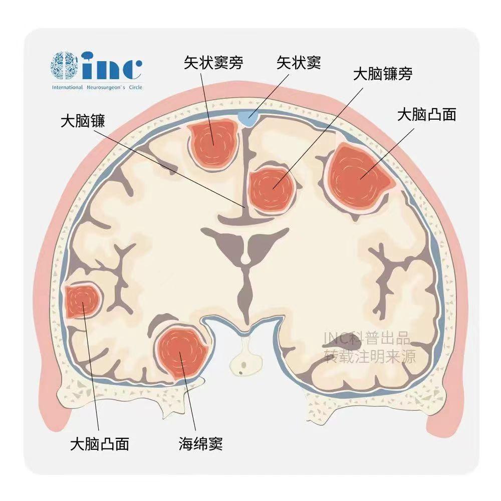 　脑膜瘤是一种存在于硬脑膜处缓慢生长的良性肿瘤，由肿瘤性脑膜上皮细胞所构成，恶性检出率不高。虽然出现恶性脑膜瘤的概率不大，但恶性脑膜瘤的临床诊断异常困难，误诊率和漏诊率较高，导致该病复发率、病死率居高不下。手术治疗、放疗、化疗、观察随访是治疗脑膜瘤的主要治疗途径，其中手术是根治性的一线解决办法，切除程度往往也决定着治愈率的高低。