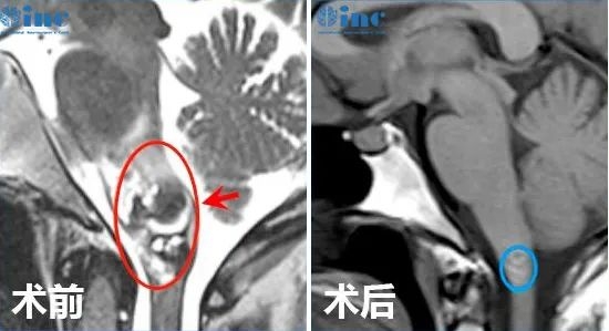 脑干海绵状血管瘤出血和复发因素是什么？