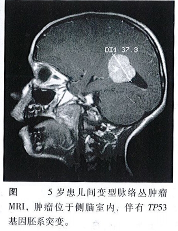 <b>脉络丛肿瘤咋回事？怎么治疗？</b>