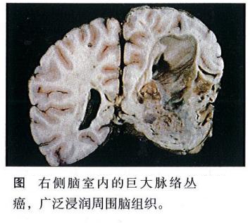 脉络丛肿瘤有哪些分型?