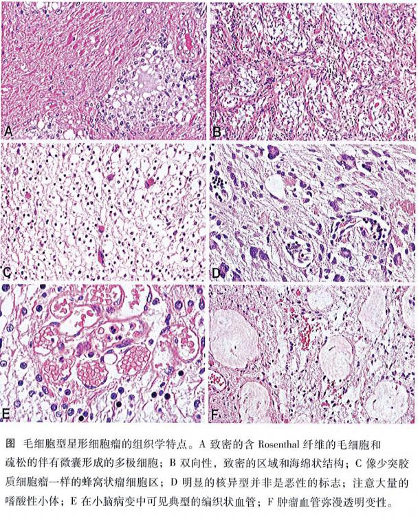 毛细胞型星形细胞瘤是怎么回事？