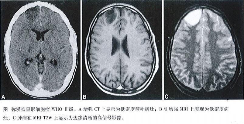 弥漫性低级别胶质瘤生存期