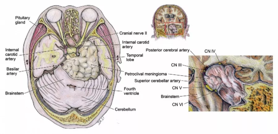 岩斜区脑膜瘤手术