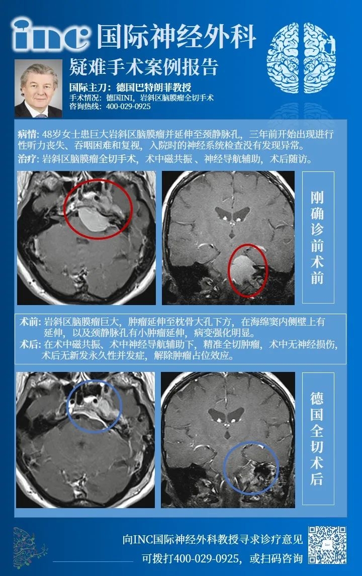 岩斜脑膜瘤手术入路案例