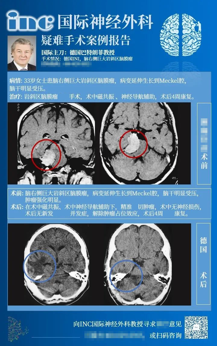 岩斜脑膜瘤手术入路案例1