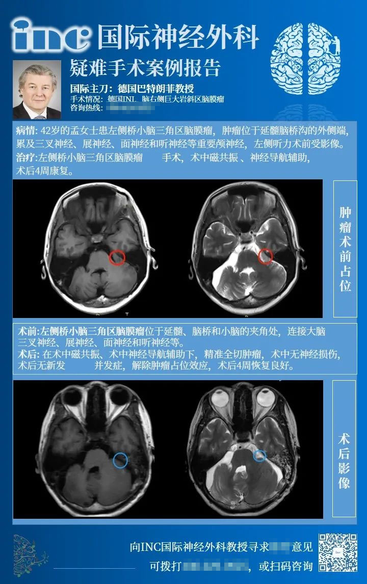 桥小脑角区脑膜瘤手术风险大吗-1