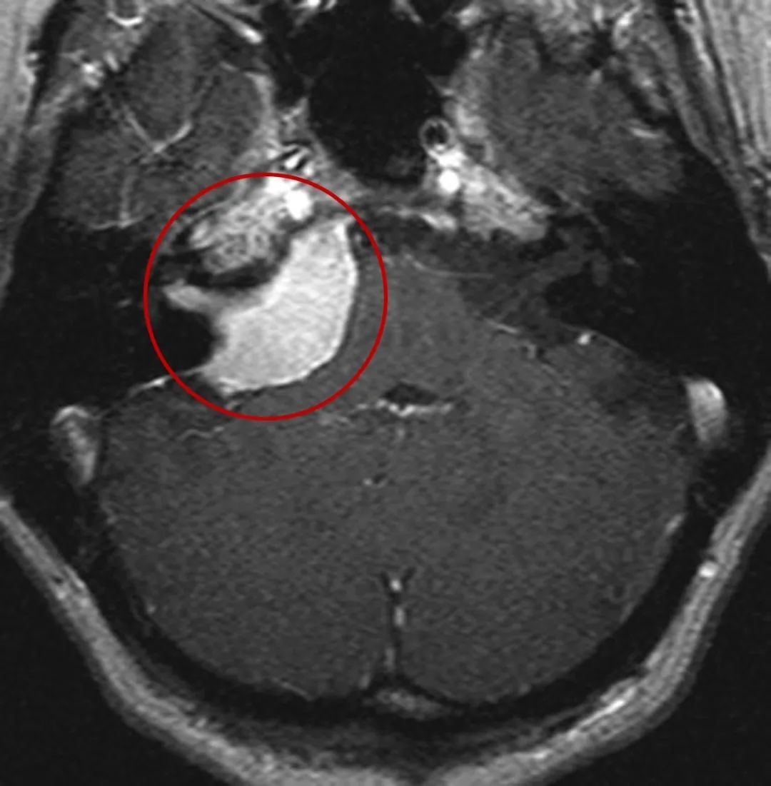 桥小脑角区脑膜瘤手术难度大吗-1