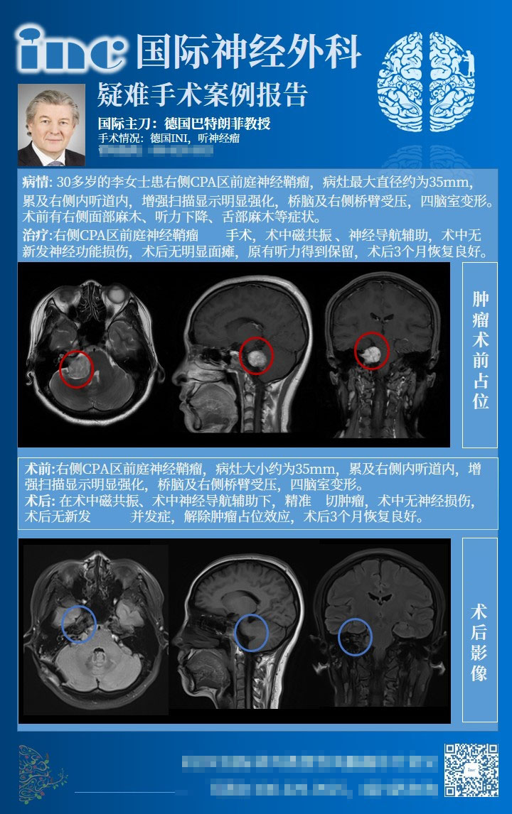 听神经瘤“保听保面”手术治疗