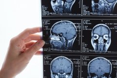 脑海绵状血管瘤的国外最新治疗进展