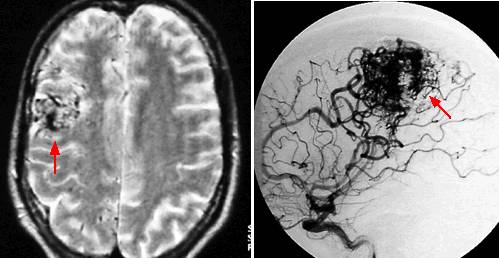 脑海绵状血管瘤