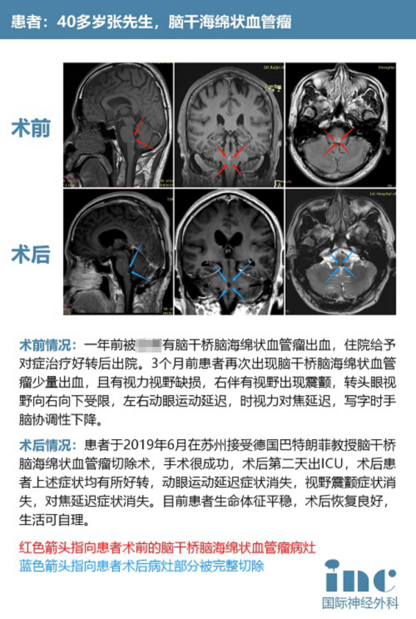 脑干海绵状血管瘤手术治疗案例