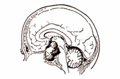 一文解析颅咽管瘤症状、可能的