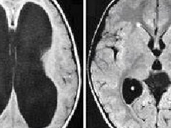 脑积水的原因是什么？婴儿、成