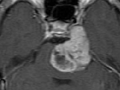 三叉神经鞘瘤的外科治疗：内镜