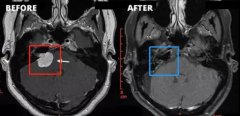 听神经瘤会自行消失吗？听神经