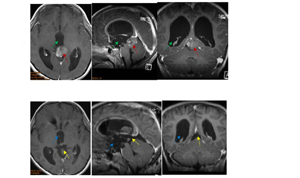 松果体肿瘤案例