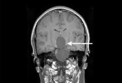颅咽管瘤严重吗？神经外科治疗