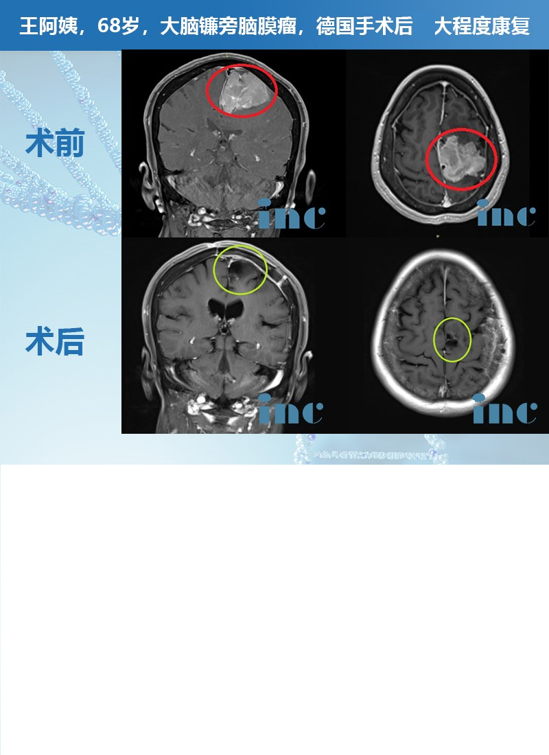 脑膜瘤案例