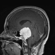 岩斜区脑膜瘤手术风险大？显微外科技术概述