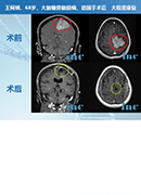 <b>大脑镰旁脑膜瘤手术风险大吗？</b>