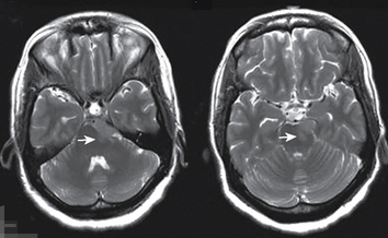 脑膜瘤为何会出现脑水肿？