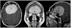 颅底脑膜瘤的手术治疗-综述