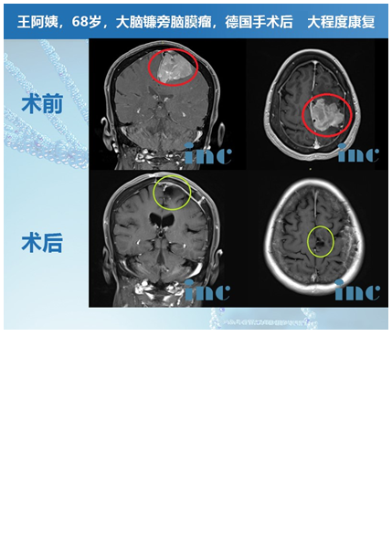 脑膜瘤案例