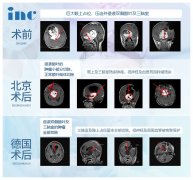 视神经通路/下丘脑低级别胶质瘤能治好吗？