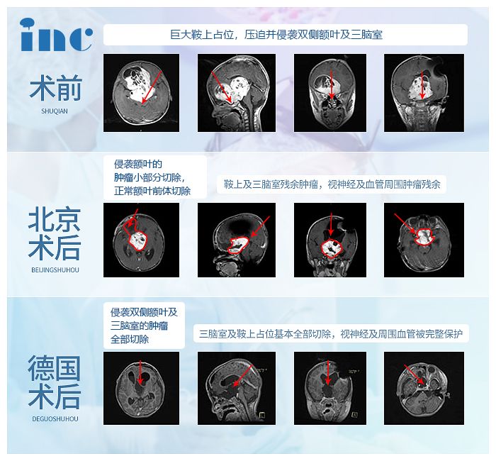 视神经胶质瘤