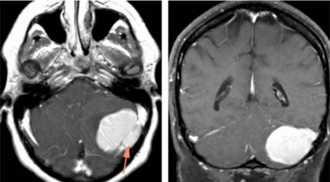 小脑脑膜瘤