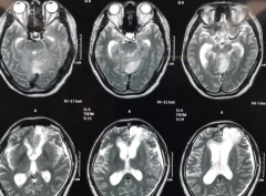 在SickKids的一次全切手术，让13岁男孩“打败”了脑胶质瘤