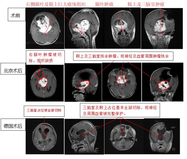 视神经胶质瘤案例