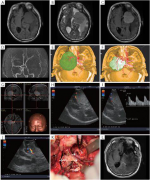 脑膜瘤手术技术：术中磁共振成像详细解读
