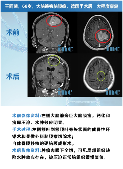 脑膜瘤案例