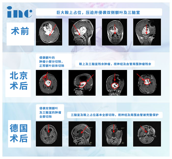 脑胶质瘤案例