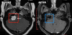 听神经瘤成功治疗的标准和生活质量解读