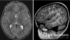 儿童额叶癫痫的神经外科治疗案