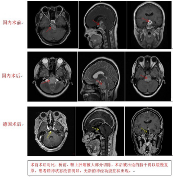 脊索瘤案例