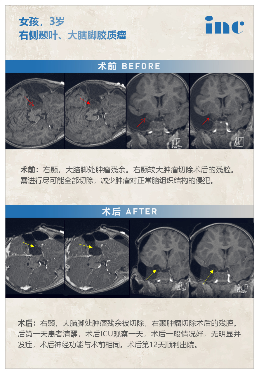 胶质瘤案例