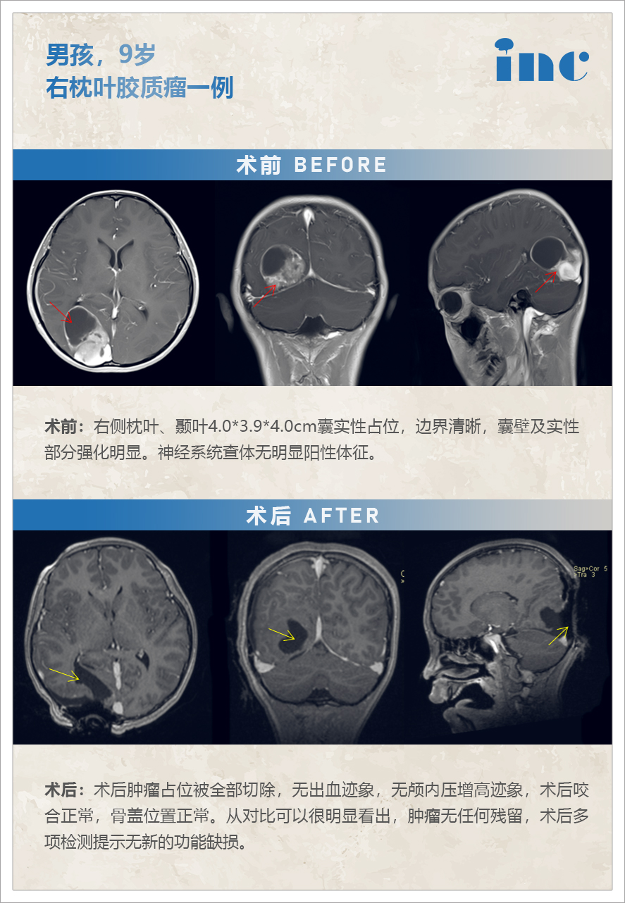 胶质瘤案例