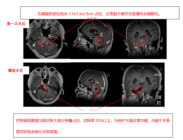 胶质母细胞瘤案例