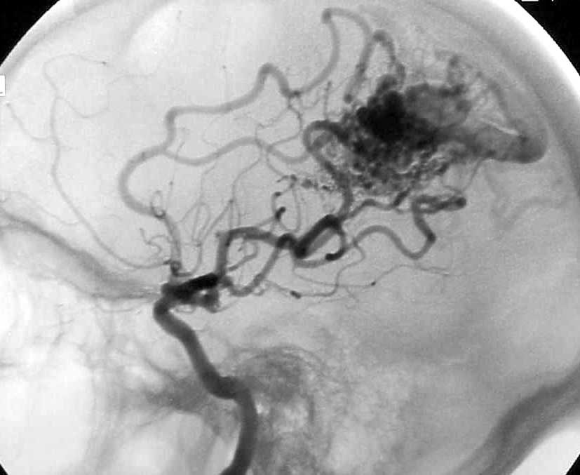 脑动静脉畸形