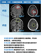 脑膜瘤诱因有哪些？脑膜瘤手术还是伽马刀治疗？