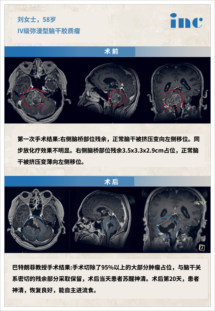 胶质瘤案例